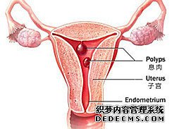 治疗宫颈息肉多少钱